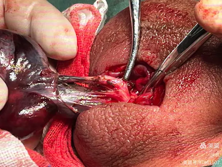 蛋蛋的忧伤,睾丸扭转